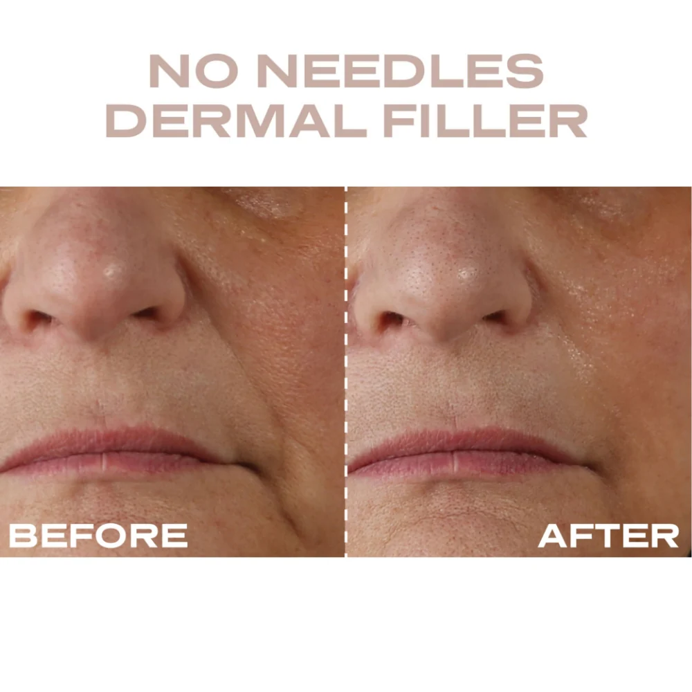 Plump It No Needles Derma Filler Pods Starter Kit 15 x 10ml - Image 10