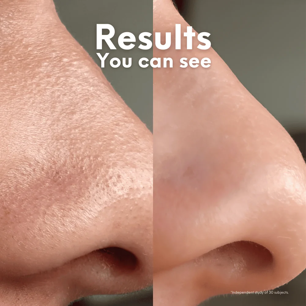 Skin Choice Breakout Patch Classic Nose x5 - Image 5